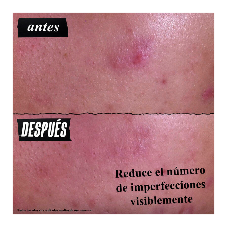 gently-effective-blemish-targeting-acne-reinigingsbehandeling